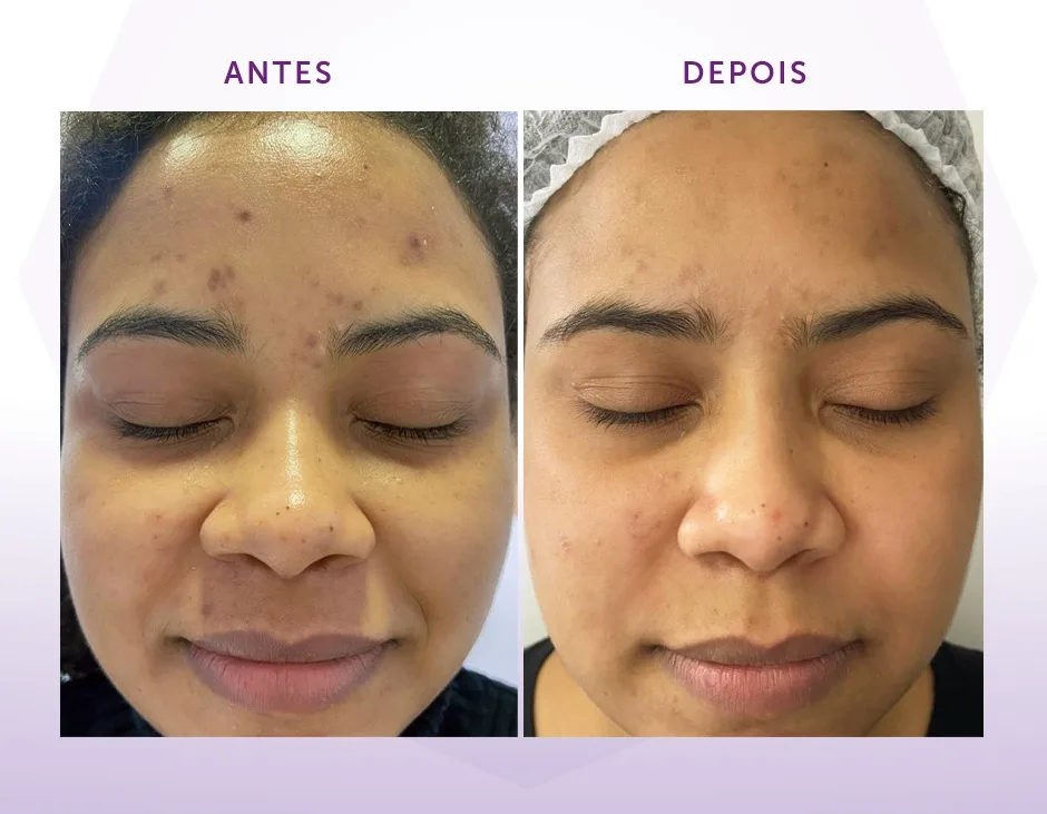 Peeling Químico Facial para renovação da pele